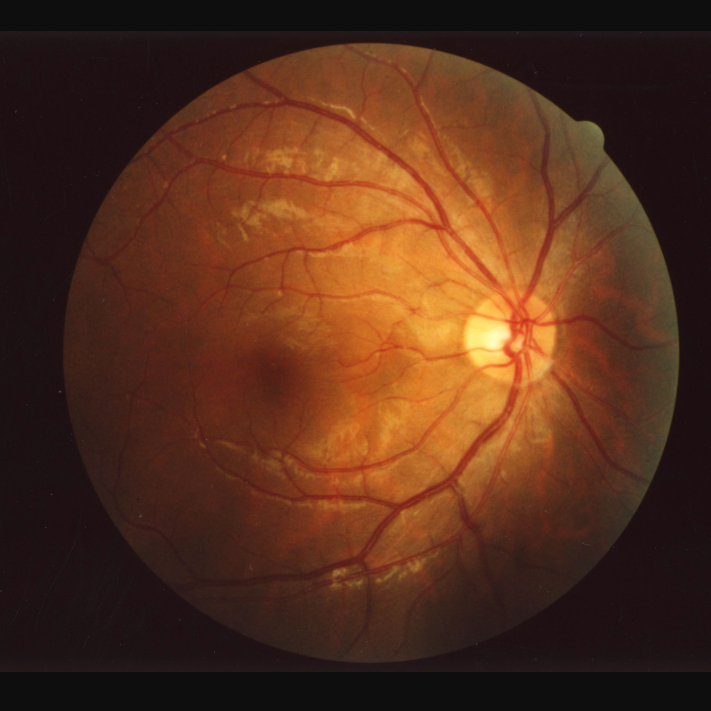 Deep-learning aging clock tracks human aging, detects eye and other diseases from retinal images