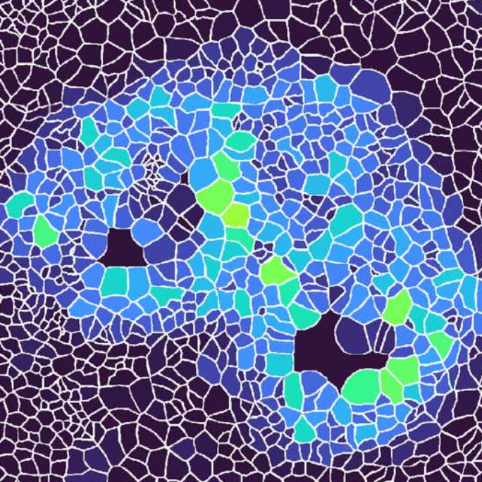 New AI tool detects cancer quicker, with sharper focus