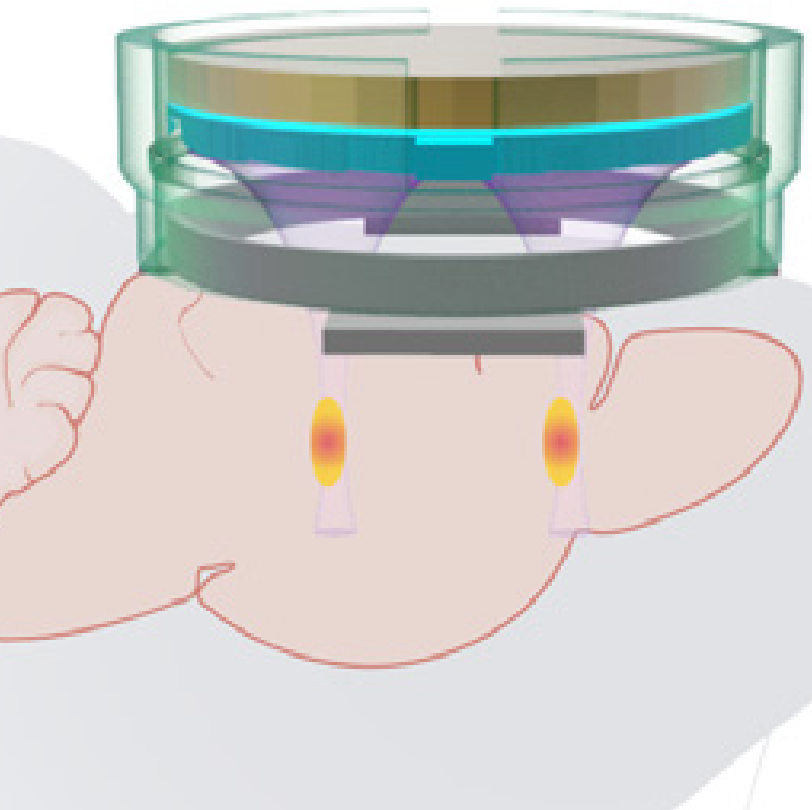 Holographic acoustic device precisely targets diseased neurons in brain