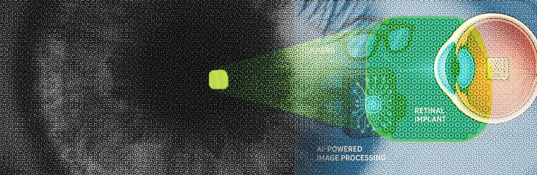 Restoring vision with the PRIMA brain-computer interface implant