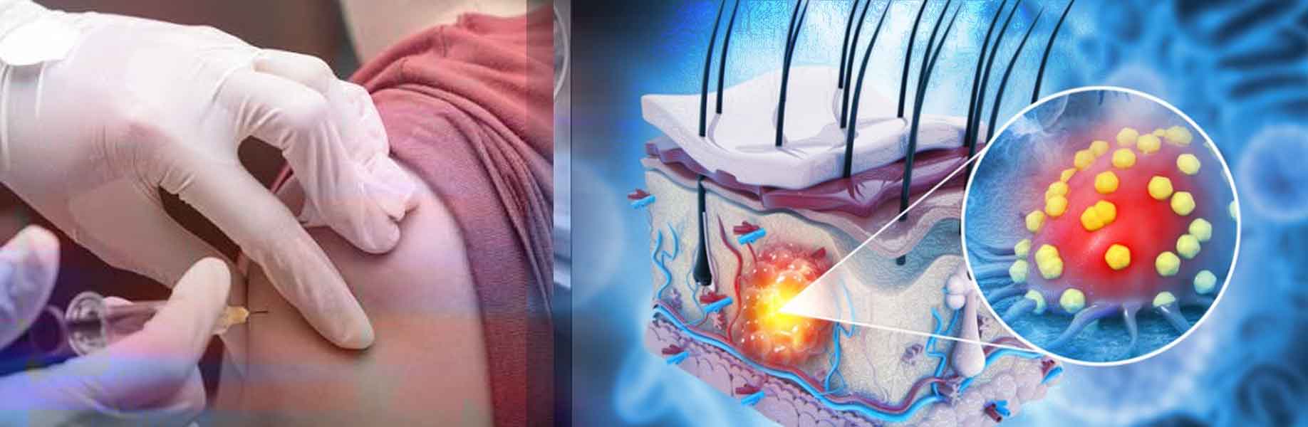 Personalized mRNA vaccine improves outcomes after melanoma surgery